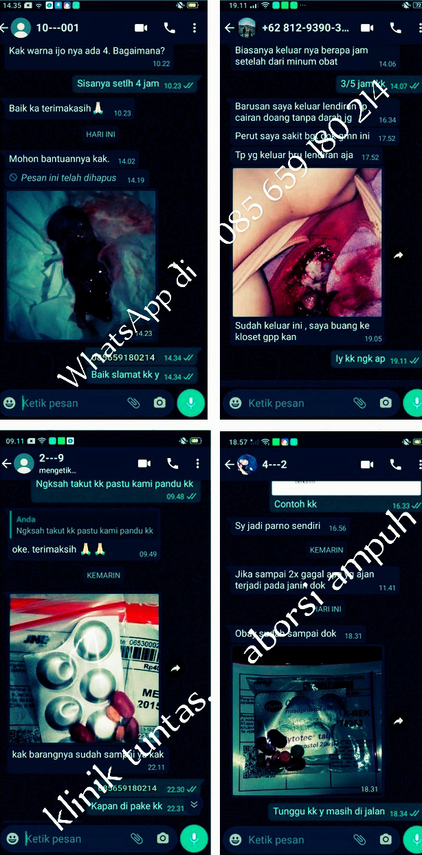 BERIKUT, INTI DARI ABORSI DENGAN AMAN DAN MANJUR BESERTA OBAT YANG PERLU ANDA KETAUI FUNGSINYA Obat Cytotec 400 mcg ® adalah nama merek dagang Misoprostol yang diproduksi oleh PFIZER yang sudah di setujui oleh US-FDA. Obat Cytotec kemasan botol dosis 400 mcg Misoprostol digunakan untuk perawatan masalah yang berkaitan dengan NSAID (Non Steroidal Anti Inflammatory Drugs) atau obat anti inflamasi non steroid (AINS). Selain itu, obat ini bisa menyebabkan kontraksi otot pada rahim yang mengarah pada di gunakan sebagai Obat Penggugur Kandungan dan Cara Menggugurkan Kandungan Atau Aborsi Medis Dengan Pil untuk gugurkan janin secara bertahap dan bersih secara tuntas.   Cyrux Pushing the Fetus and Misoprostol 200 mcg merupakan obat pendorong janin yang memiliki nama paten Cyrux, Obat ini termasuk obat aborsi medis, Maka anda dapat mengkonsumsi obat ini sebagai solusinya. Cyrux berfungsi sebagai obat pendorong janin untuk mendorong / mengeluarkan janin dan sisa-sisa darah yang ada di rahim yang berguna untuk menuntaskan dan pembersih rahim yang ada di kandungan. Dari pengalaman mereka yang menggunakan Obat Cytotec 400 mcg dan Cyrux Misoprostol 200 mg, selama proses aborsi tidak terjadi perdarahan yang berlebihan. Karena Obat Cyrux berguna untuk membersihkan sekaligus mendorong janin Anda yang kuat dan sulit untuk di gugurkan.  Keterangan Dosis  Untuk dosis Cytotec 200mcg kemasan tablet baik untuk memicu usia kandungan yg masih muda usia 1 Minggu hingga usia 2 - 3 bulan. Supaya tidak terjadi kontraksi yg berlebih  Untuk dosis Cytotec 400 mcg bentuk Kemasan botol baik untuk memicu Kontraksi usia kandungan Janin yg sudah berbentuk usia 3 bulan sampai 6-7bulan. dosis yg cocok di pakai dan di anjurkan.  Testimoni setelah menggunakan obat.